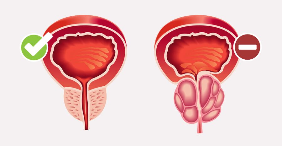 Prostamin Forte normalizează dimensiunea și funcția prostatei